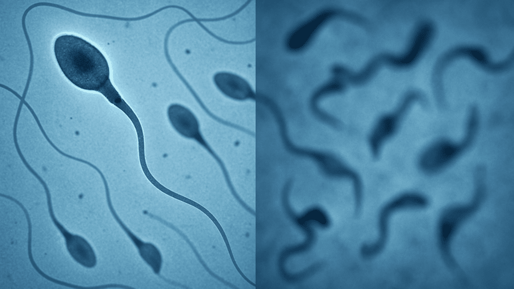 Comparación microscópica de espermatozoides sanos y dañados, que ilustra los efectos de las enfermedades autoinmunes en la fertilidad masculina.